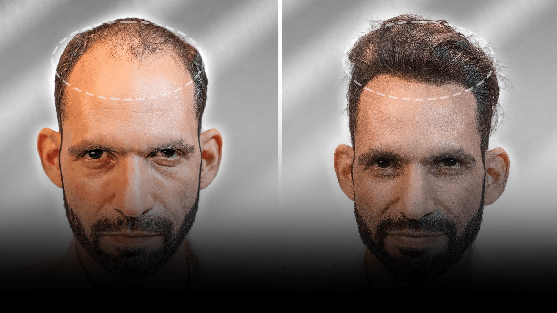 Before and after stick-on hair system result for Saurabh Mishra.