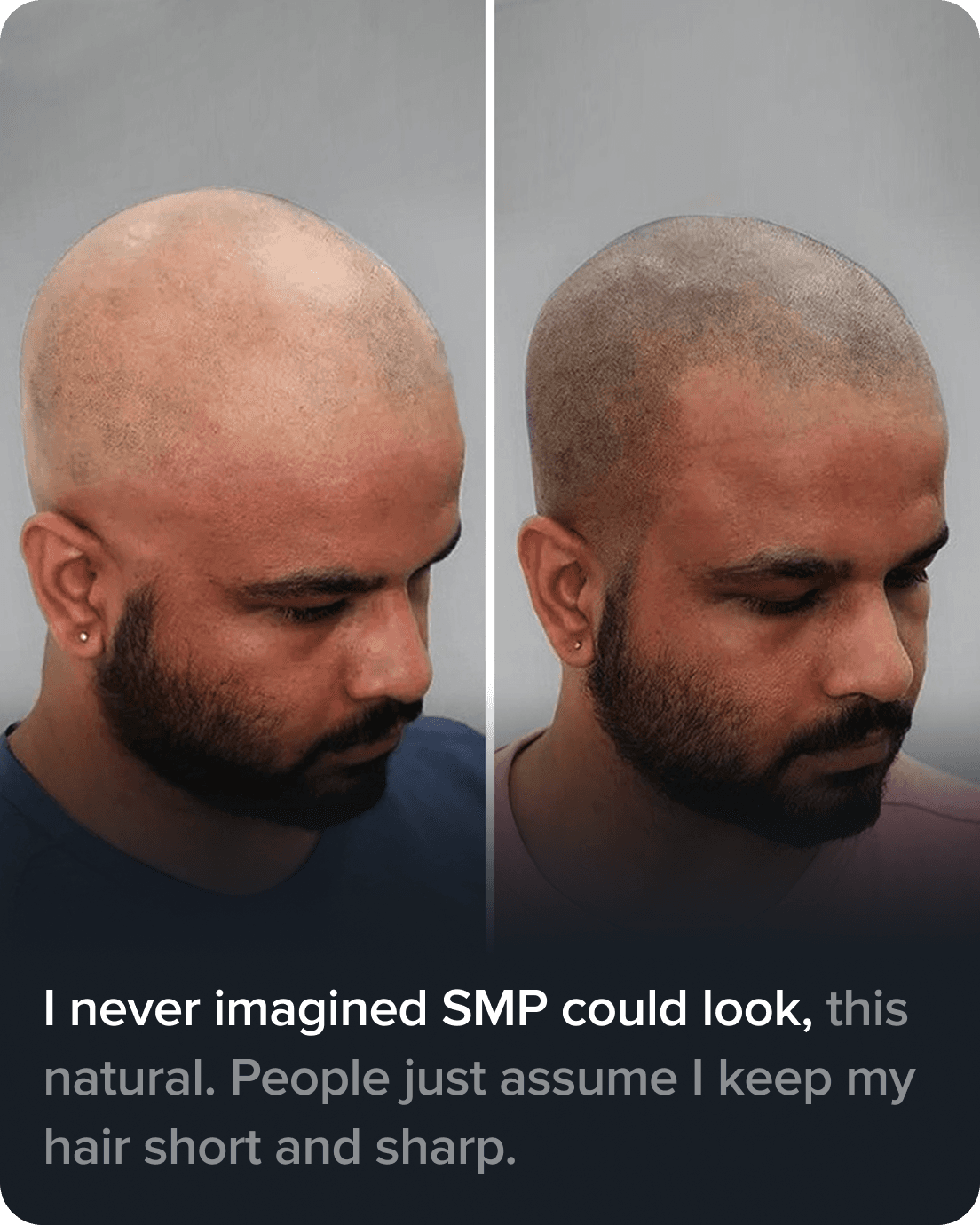 Scalp Micro Pigmentation real result transformation 1