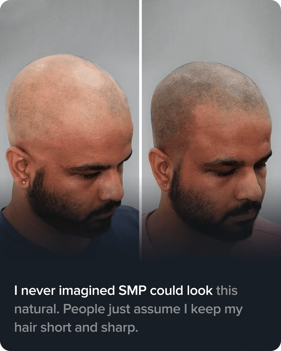 Scalp Micro Pigmentation real result transformation 1