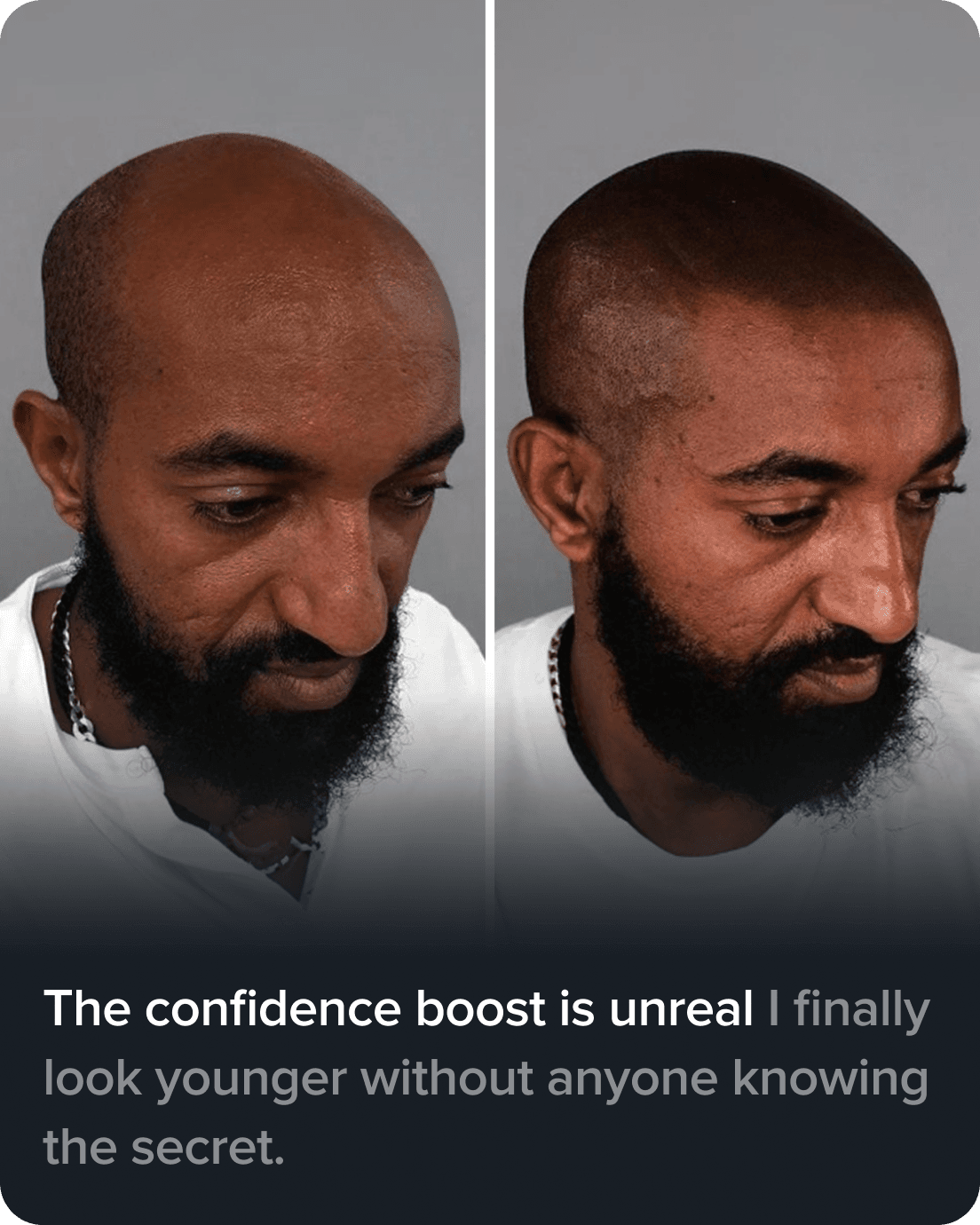 Scalp Micro Pigmentation real result transformation 2