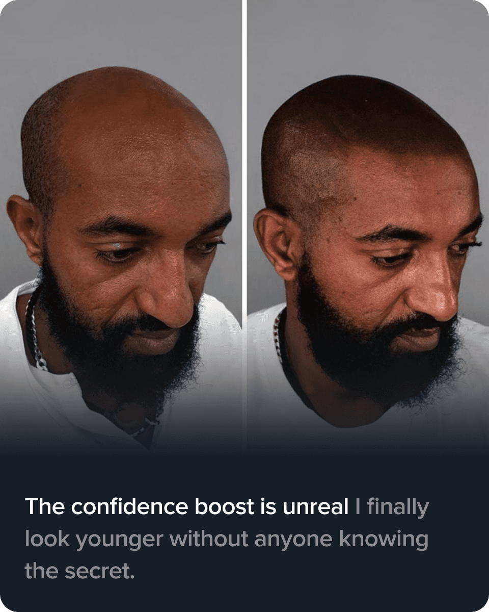 Scalp Micro Pigmentation real result transformation 2
