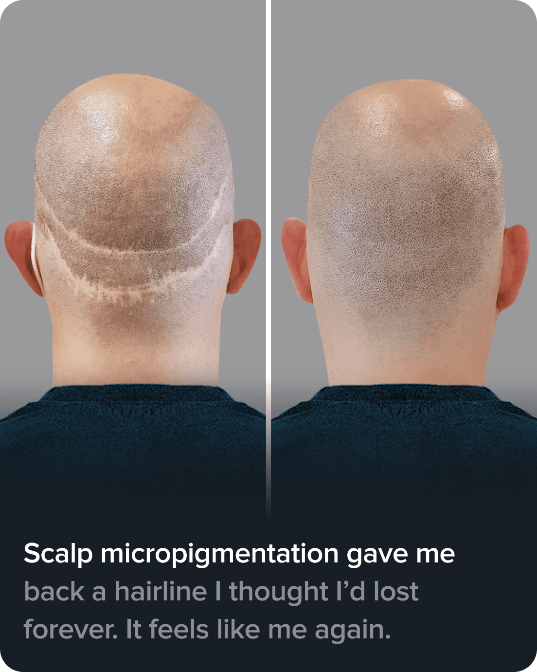 Scalp Micro Pigmentation real result transformation 3