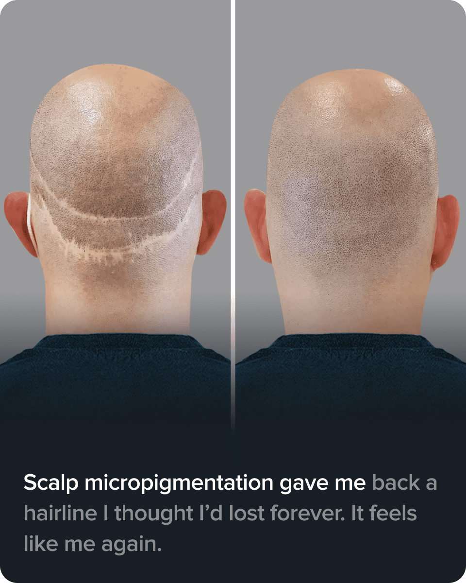 Scalp Micro Pigmentation real result transformation 3