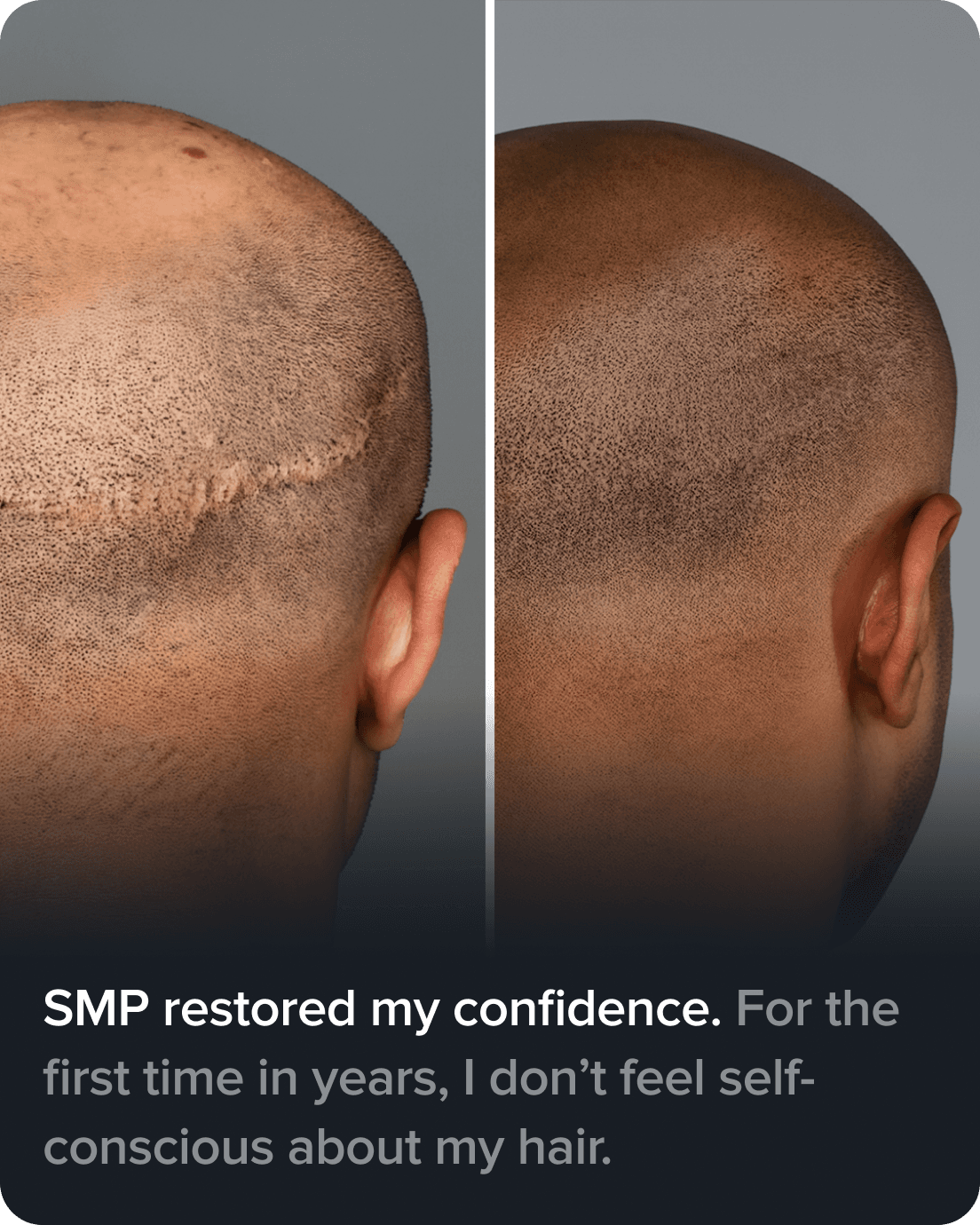 Scalp Micro Pigmentation real result transformation 4