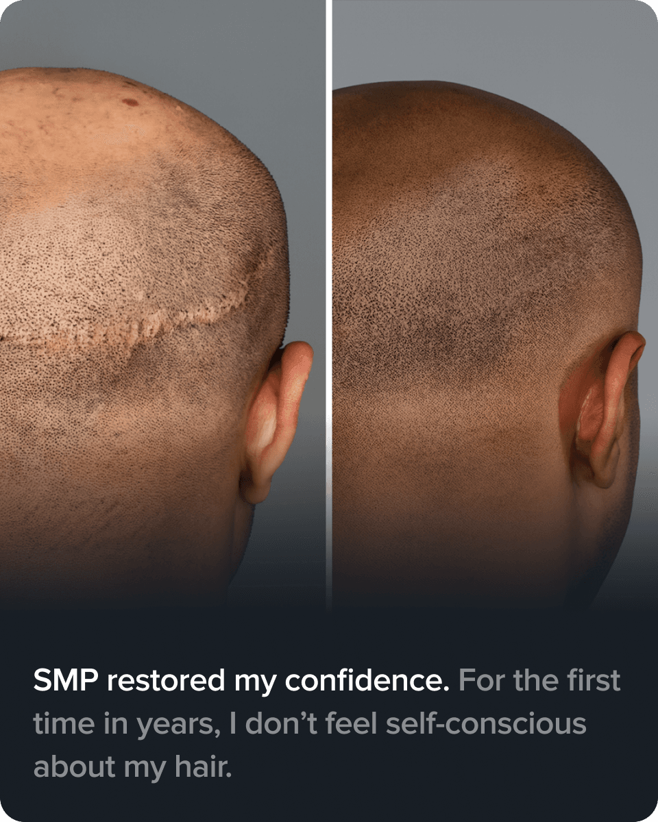 Scalp Micro Pigmentation real result transformation 4