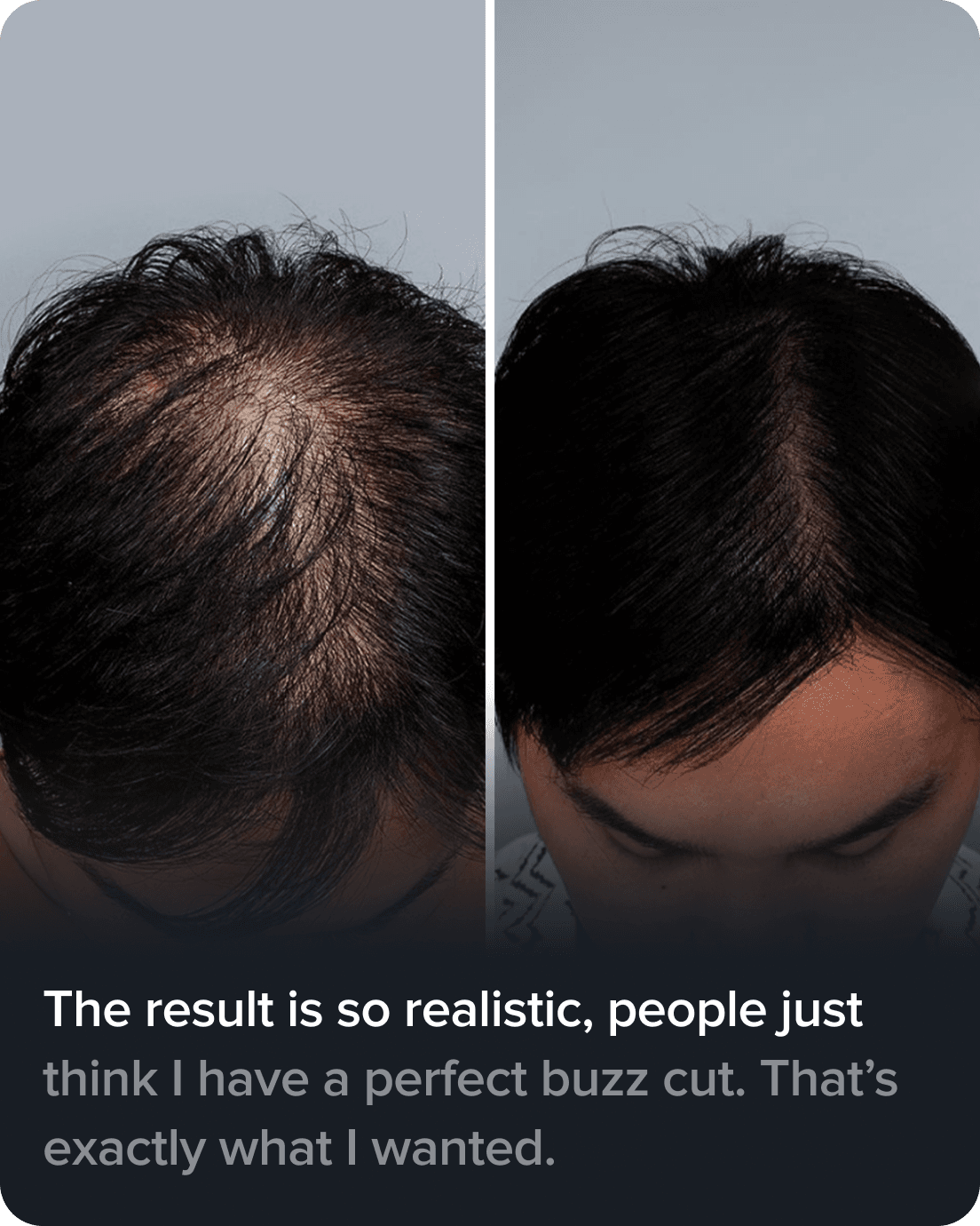 Scalp Micro Pigmentation real result transformation 5