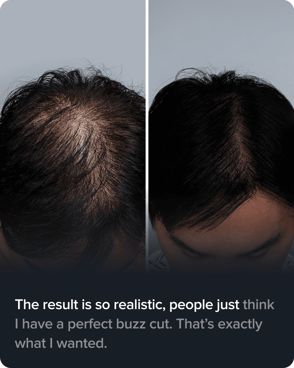 Scalp Micro Pigmentation real result transformation 5