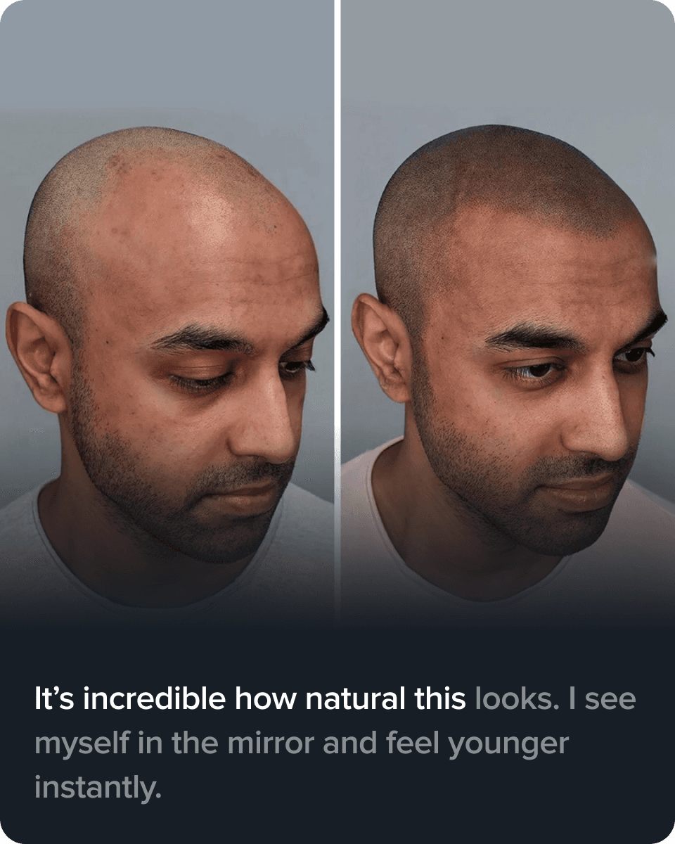 Scalp Micro Pigmentation real result transformation 6