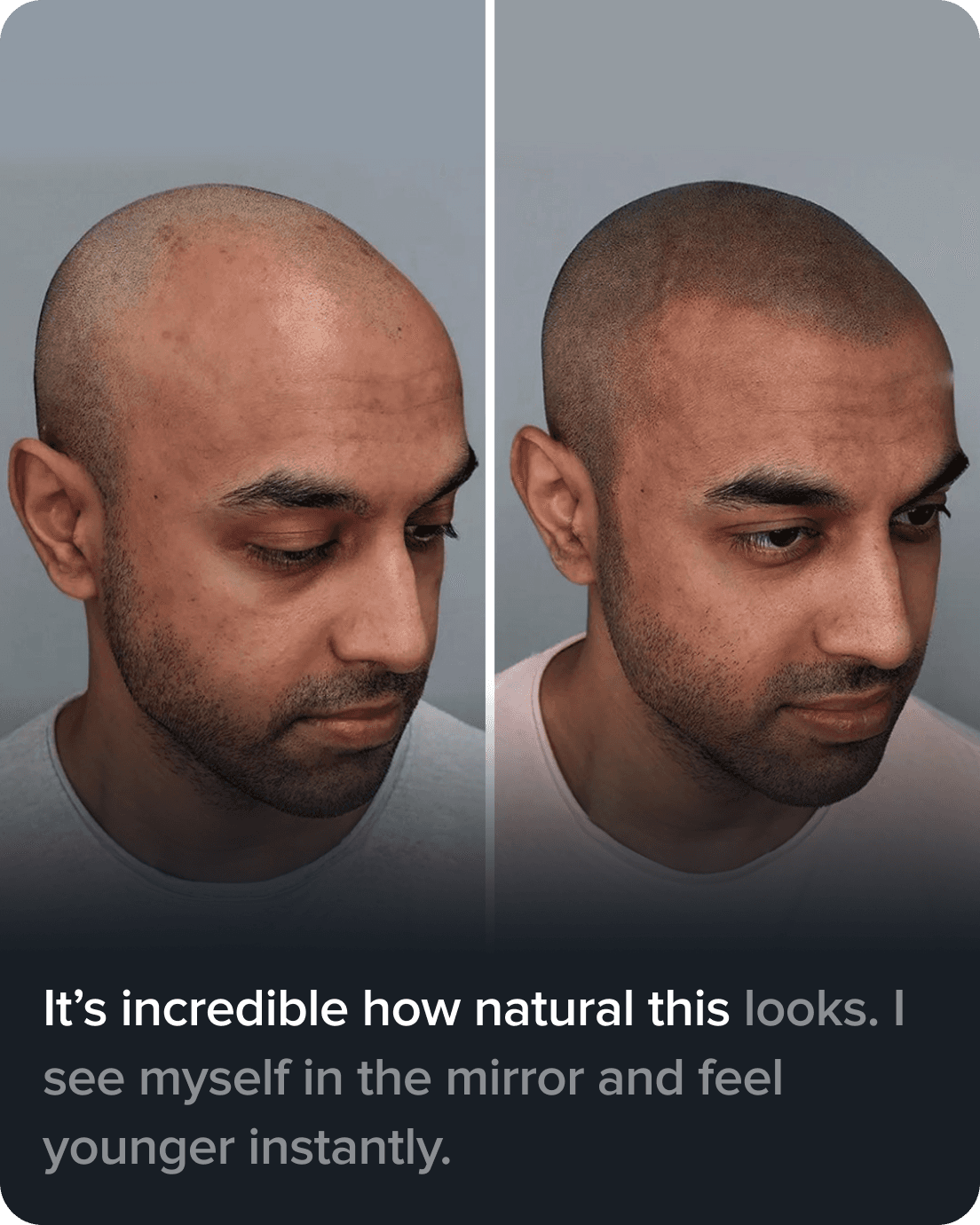 Scalp Micro Pigmentation real result transformation 6