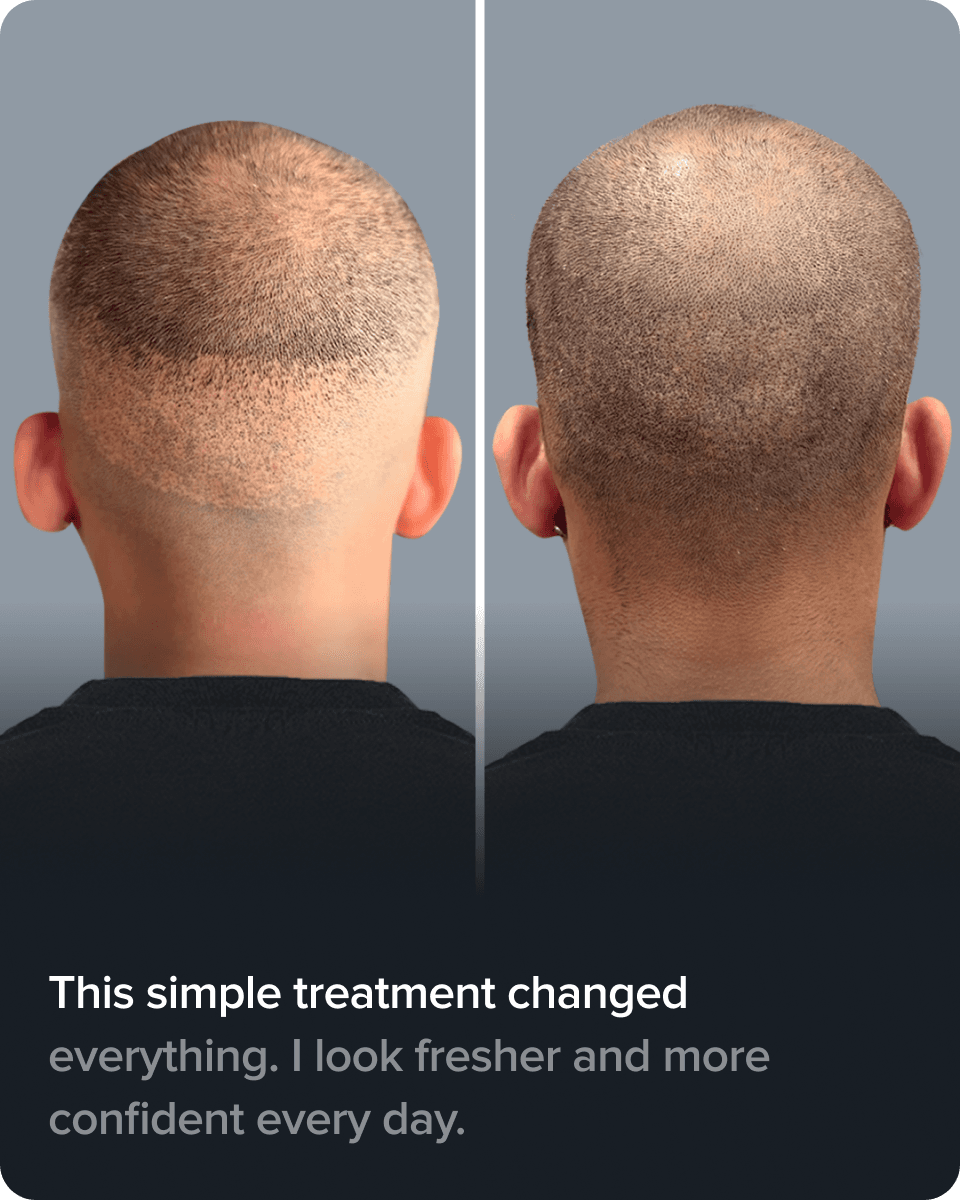 Scalp Micro Pigmentation real result transformation 7