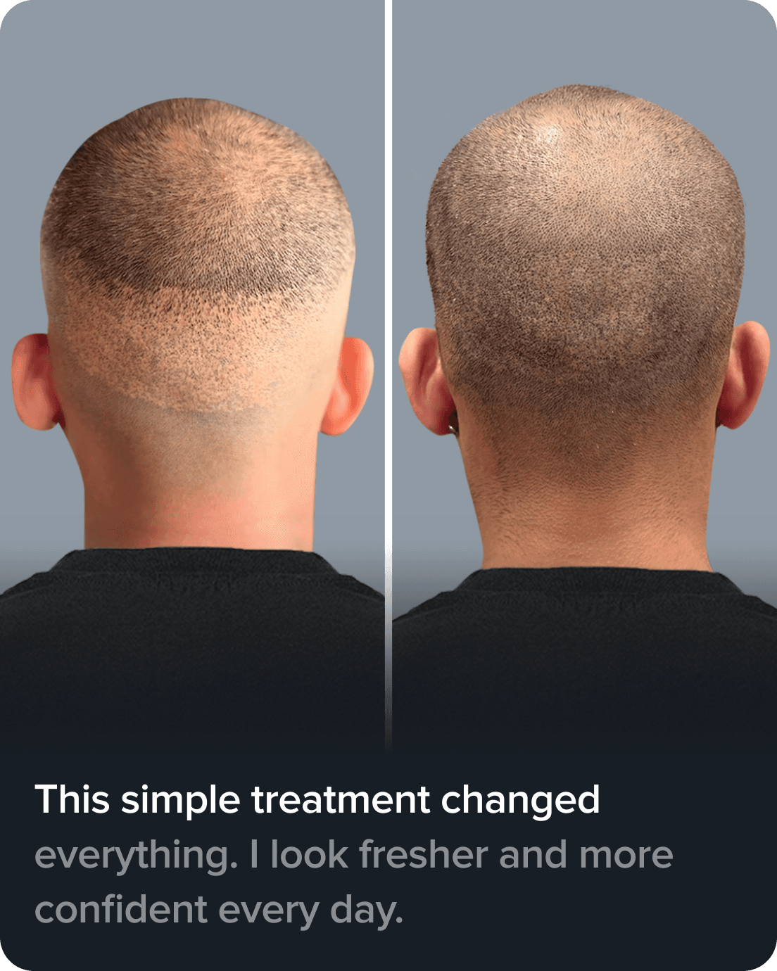 Scalp Micro Pigmentation real result transformation 7