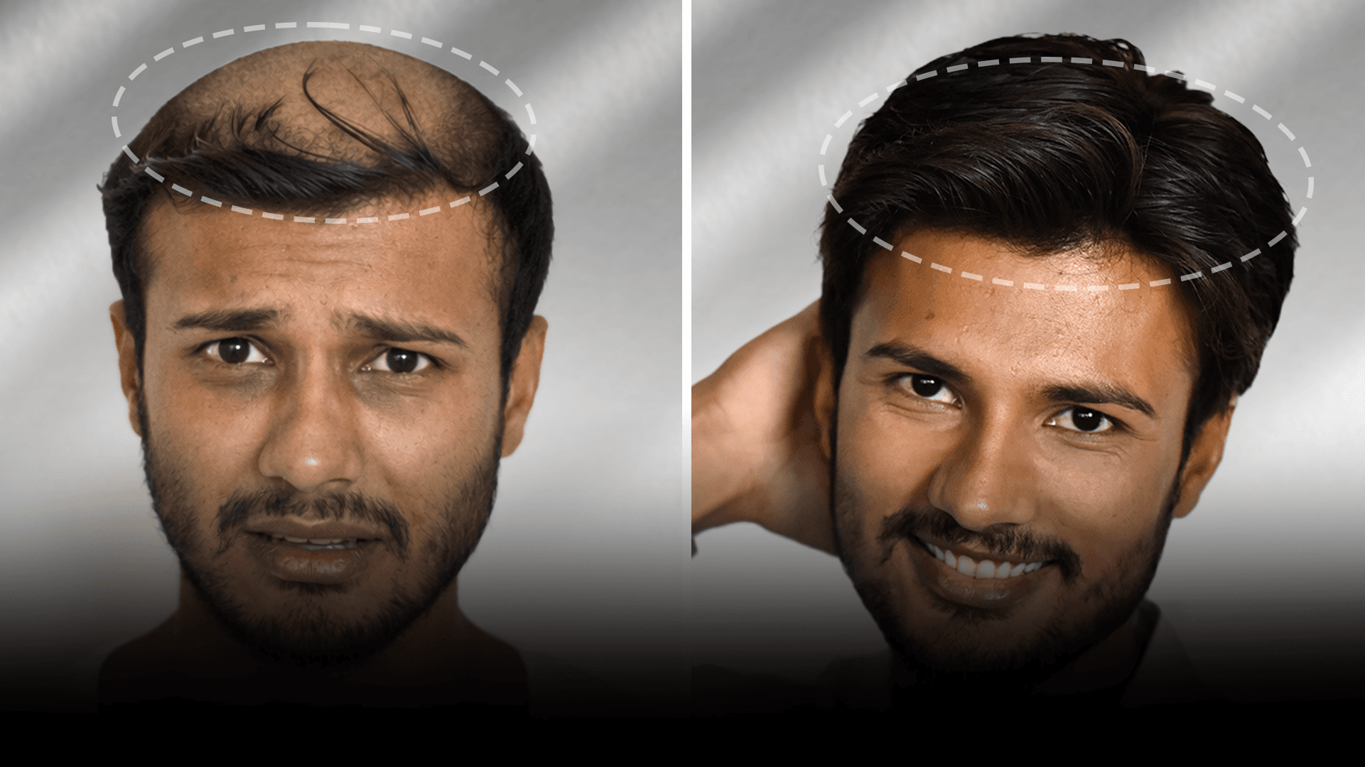 Before and after clip-on hair system result for Advik Sharma in the high density category.