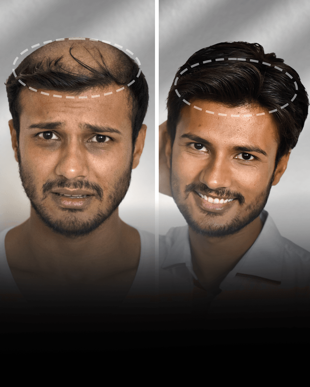 Before and after clip-on hair system result for Advik Sharma in the medium hair category.