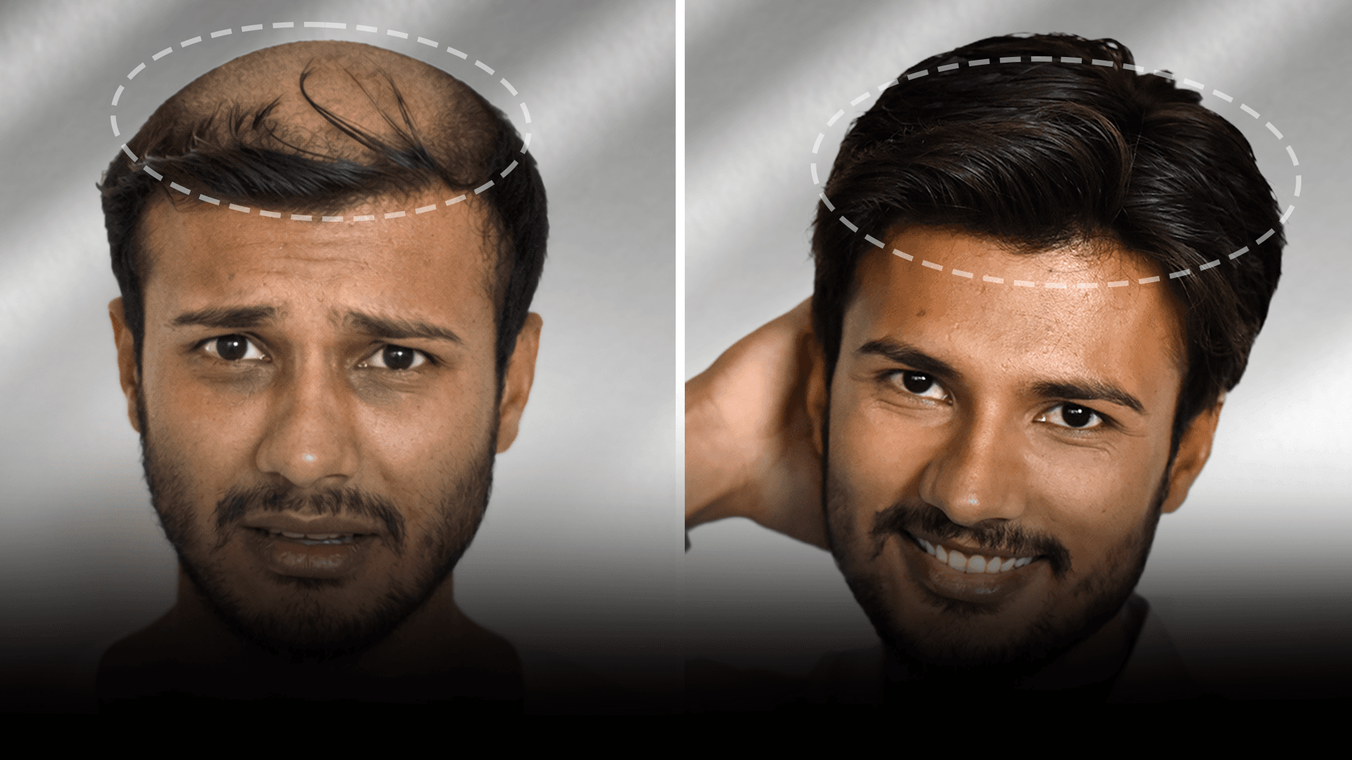 Before and after clip-on hair system result for Advit Sharma.