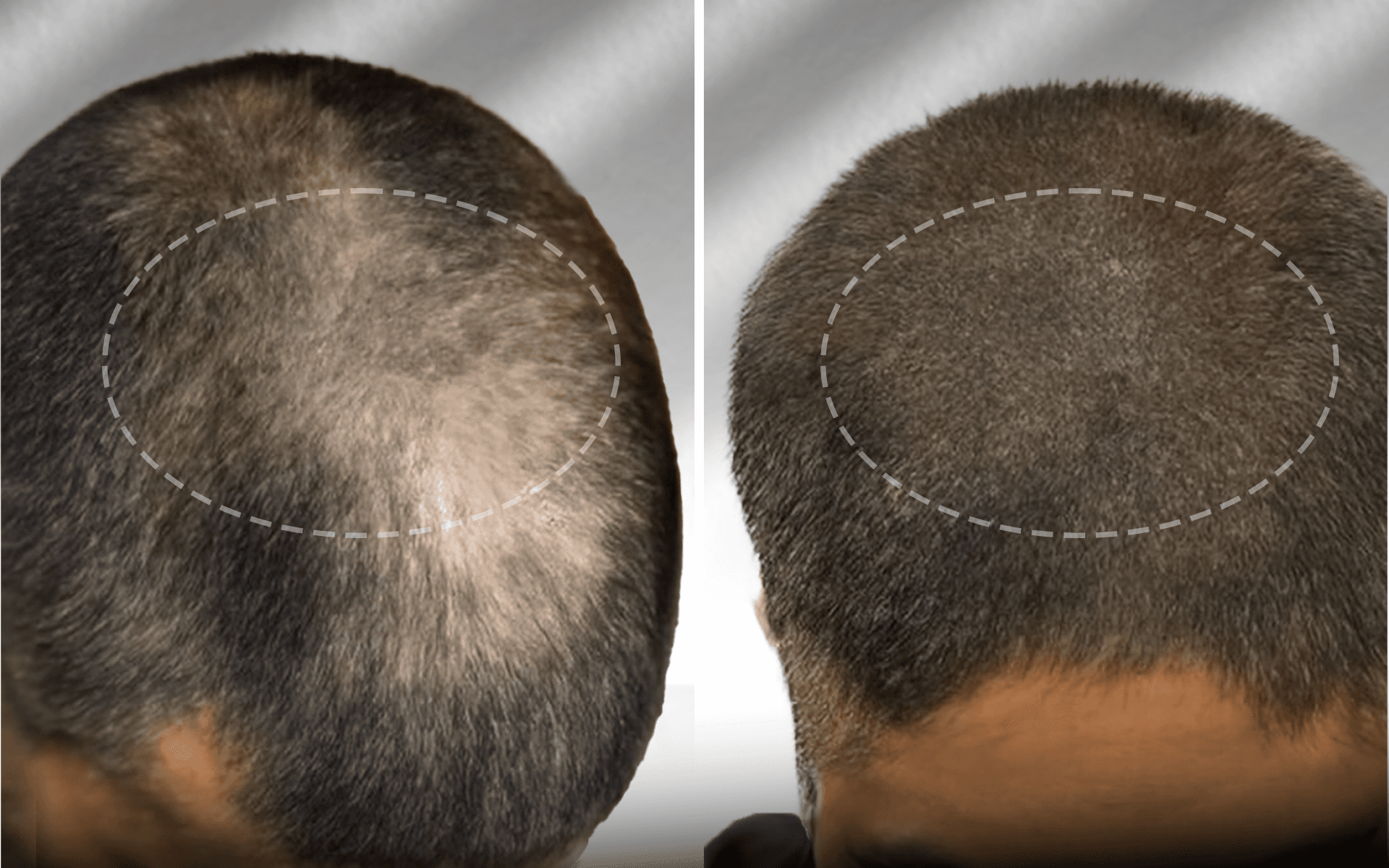 SMP treatment for alopecia — scalp micropigmentation result showing restored density