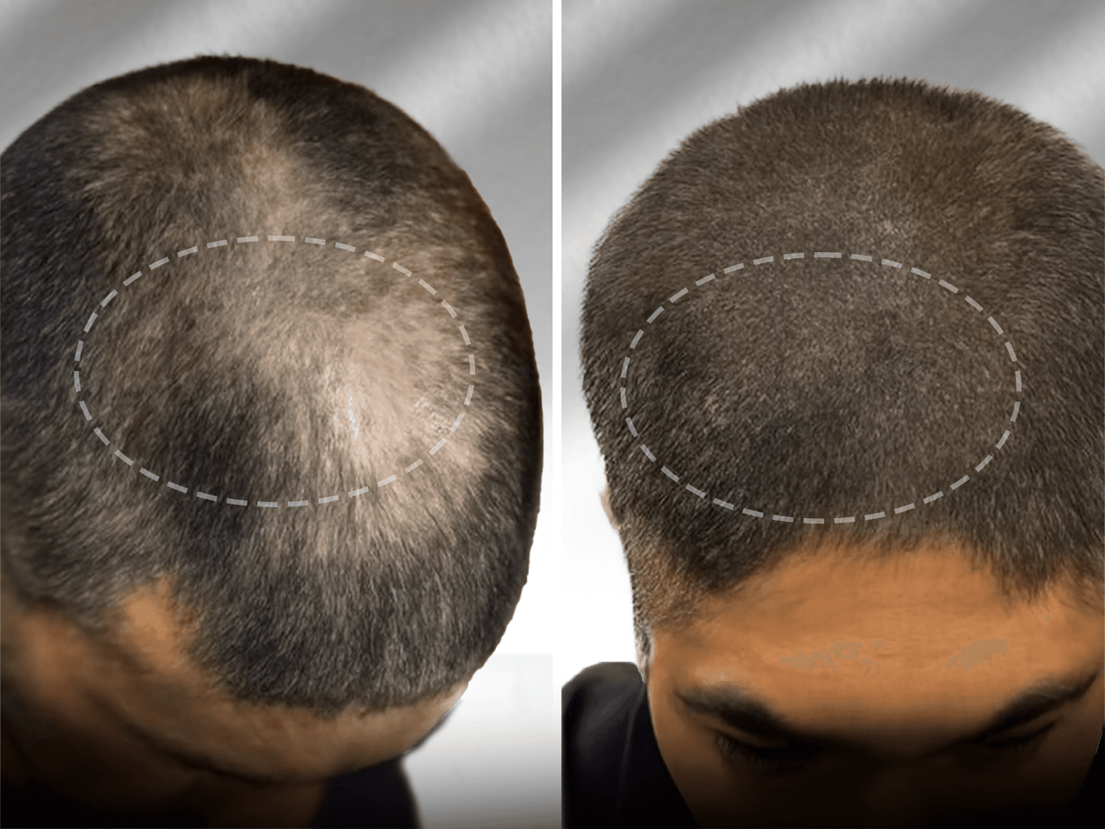SMP treatment for alopecia — scalp micropigmentation result showing restored density