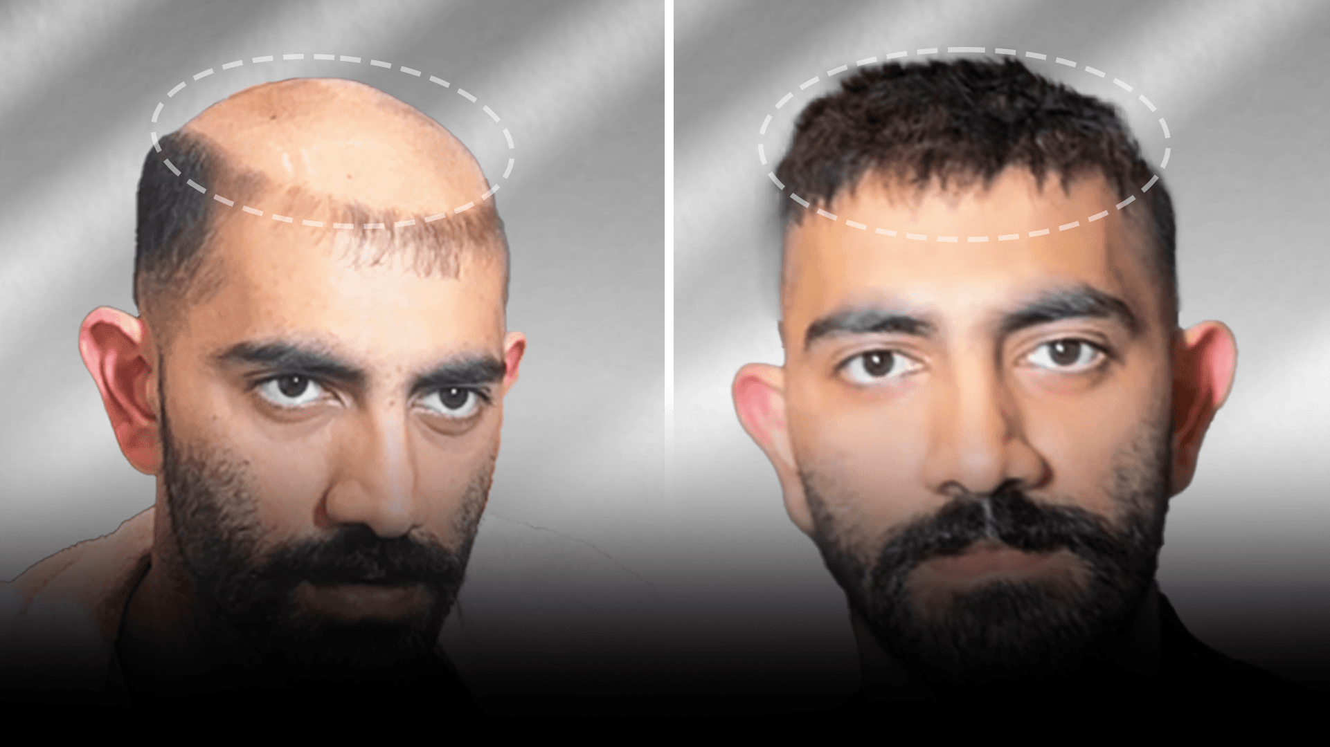 Before and after stick-on hair system result for Azhar Shaikh in the low density category.