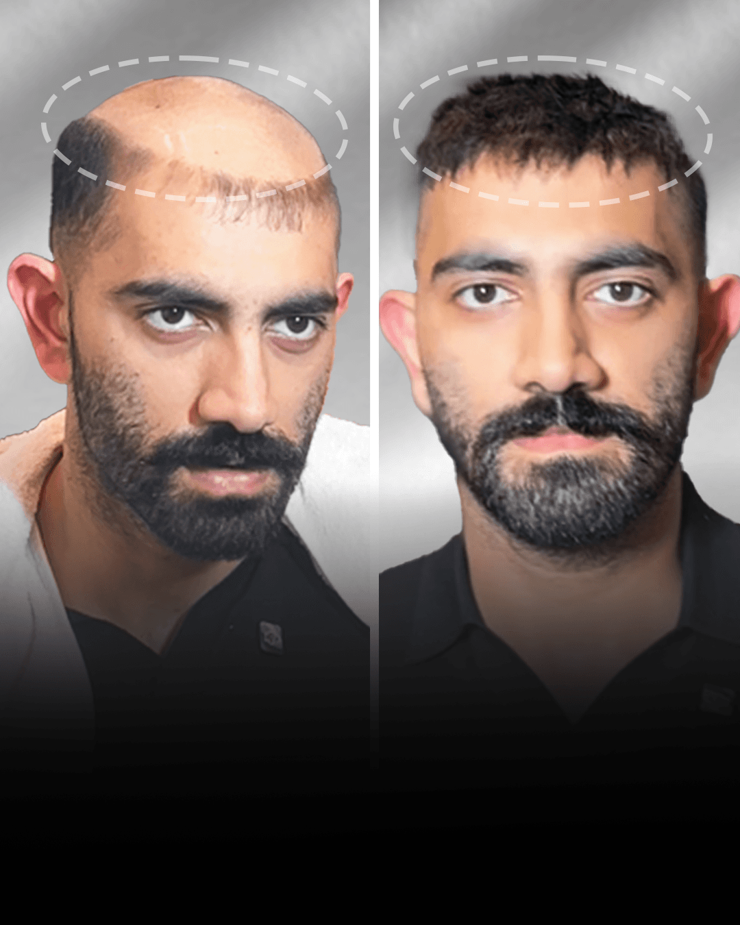 Before and after stick-on hair system result for Azhar Shaikh in the short hair category.