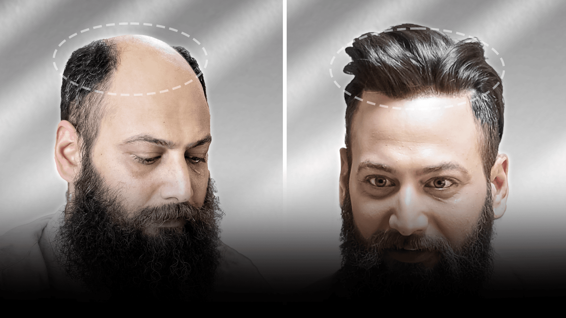 Before and after stick-on hair system result for Chandan Singh in the high density category.