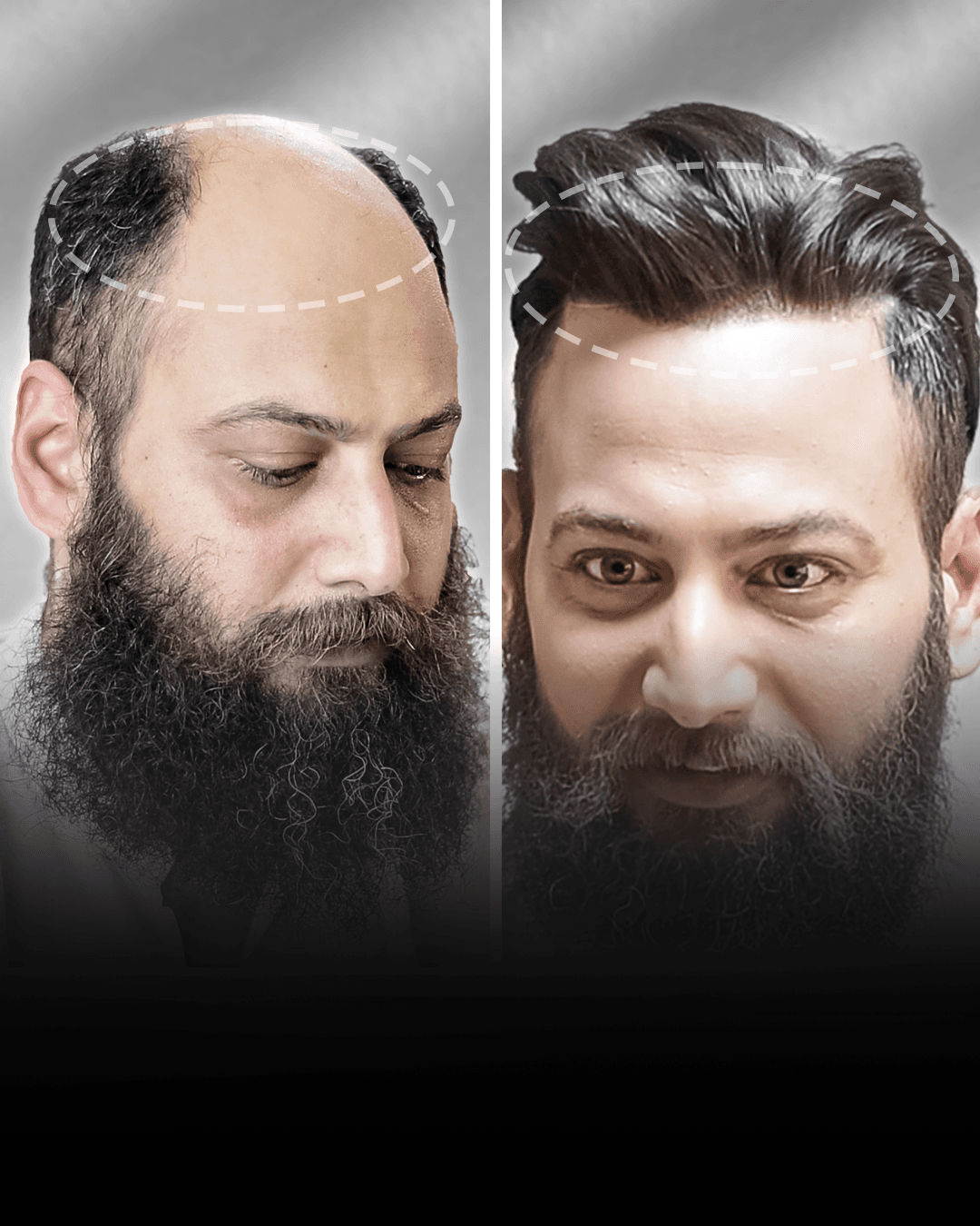 Before and after stick-on hair system result for Chandan Singh in the high density category.