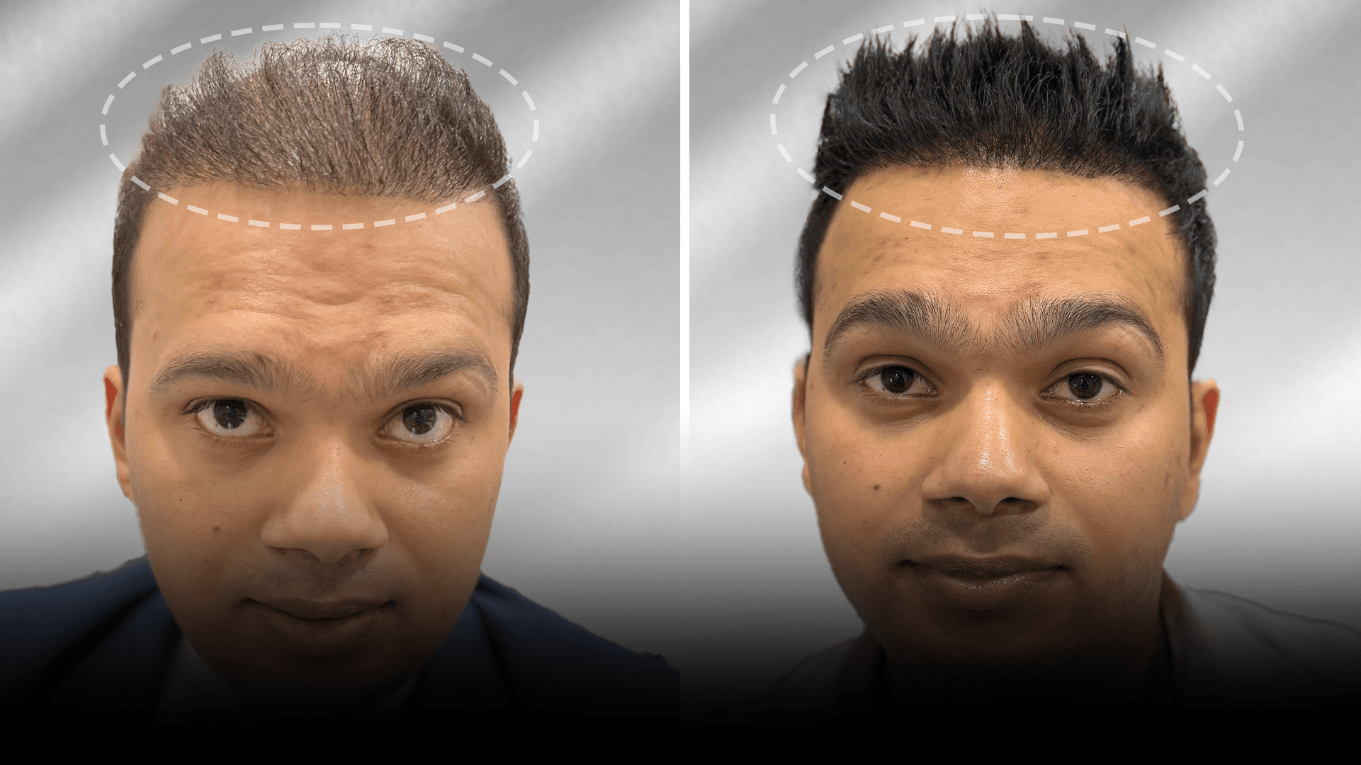 Before and after clip-on hair system result for Fuzail Khan in the short hair category.