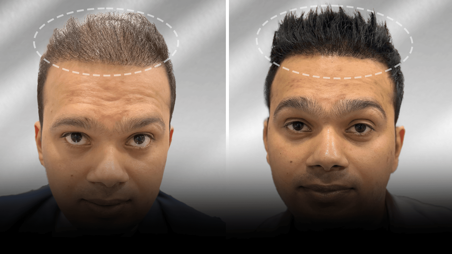 Before and after clip-on hair system result for Fuzail Khan in the low density category.