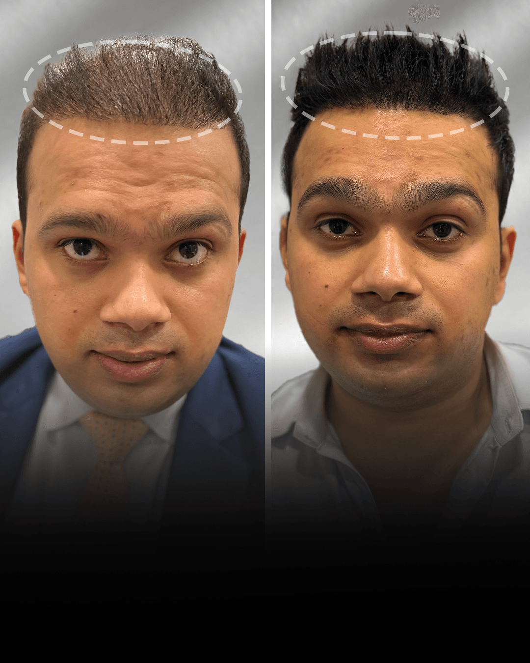 Before and after clip-on hair system result for Fuzail Khan in the short hair category.