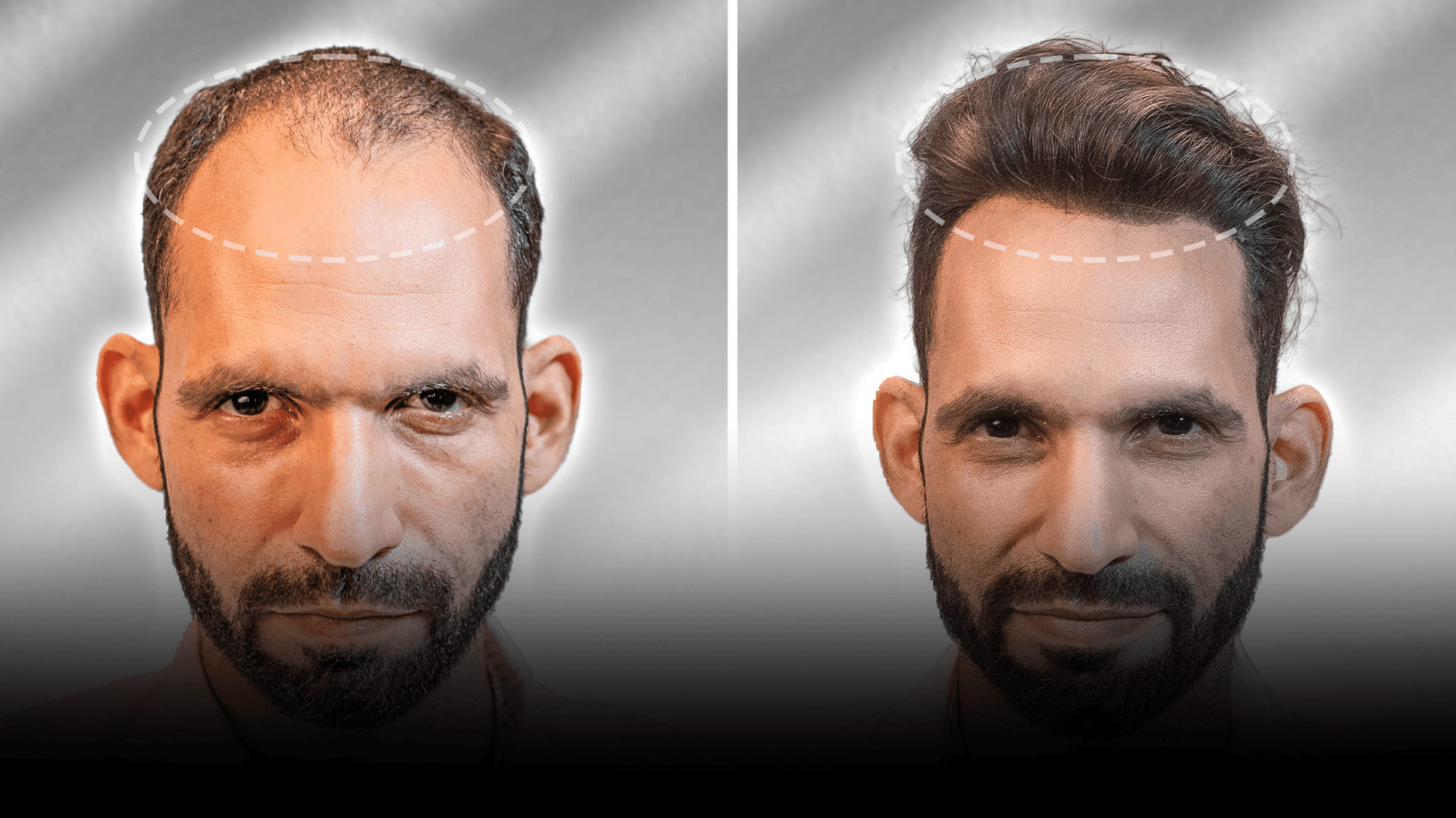 Before and after stick-on hair system result for Manish Yadav in the medium hair category.