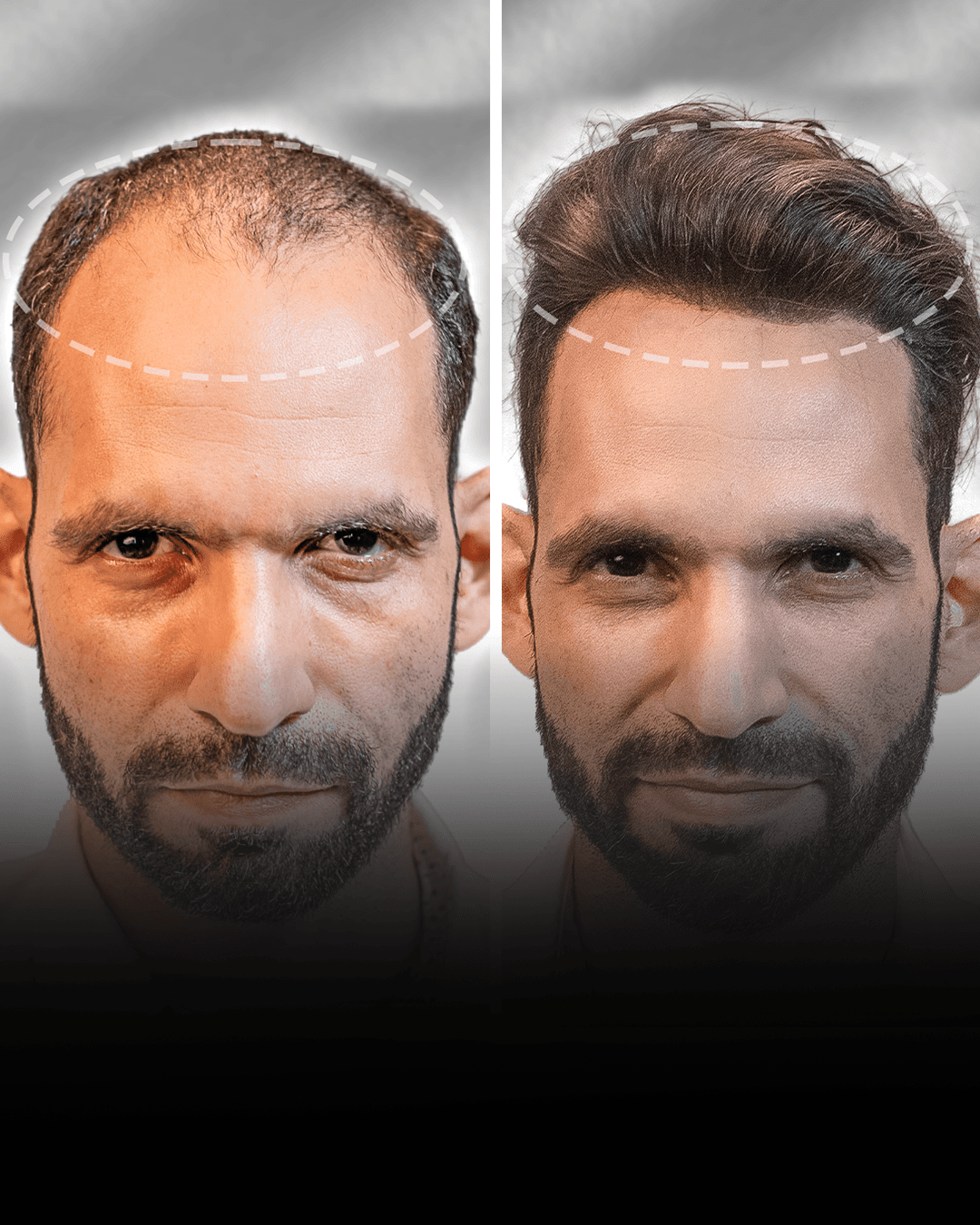 Before and after stick-on hair system result for Manish Yadav in the medium hair category.