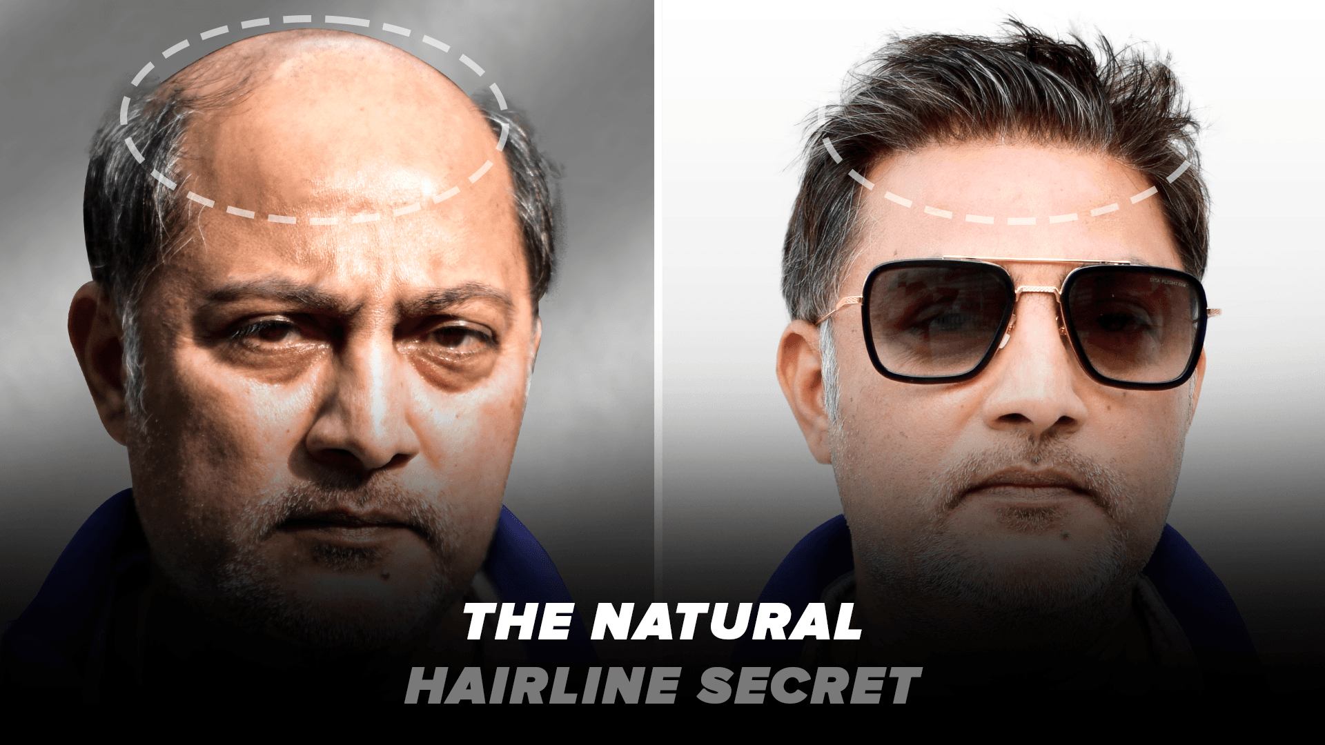 Natural-looking hairline before and after transformation.