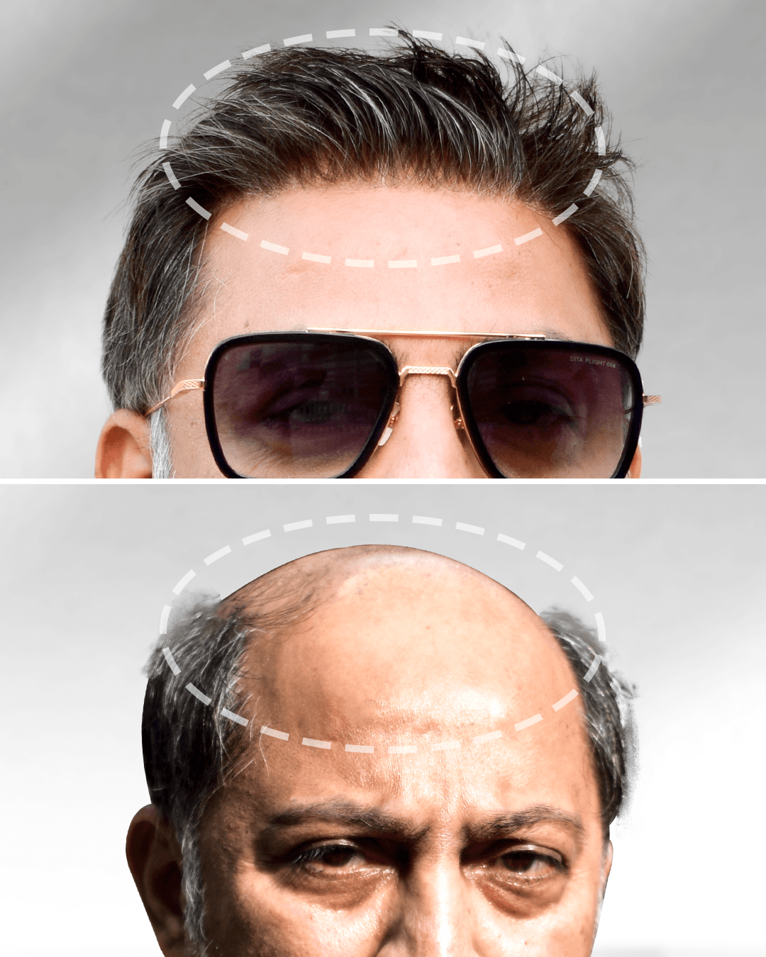 Natural-looking hairline before and after transformation.