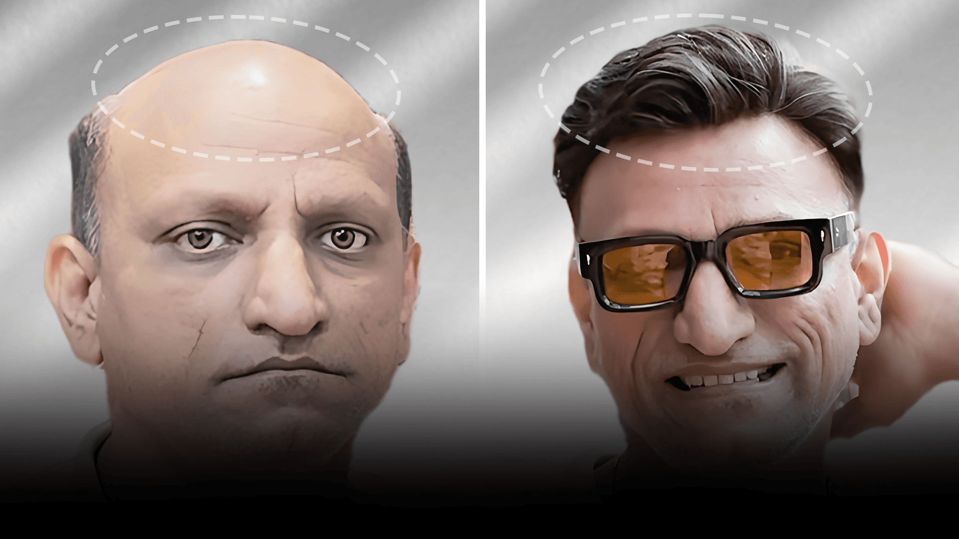 Before and after stick-on hair system result for Nikhil Pawar in the medium hair category.