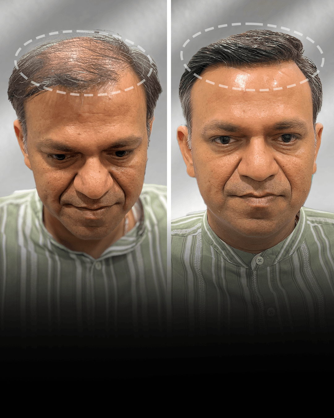 Before and after clip-on hair system result for Pankaj Bhatia in the medium hair category.