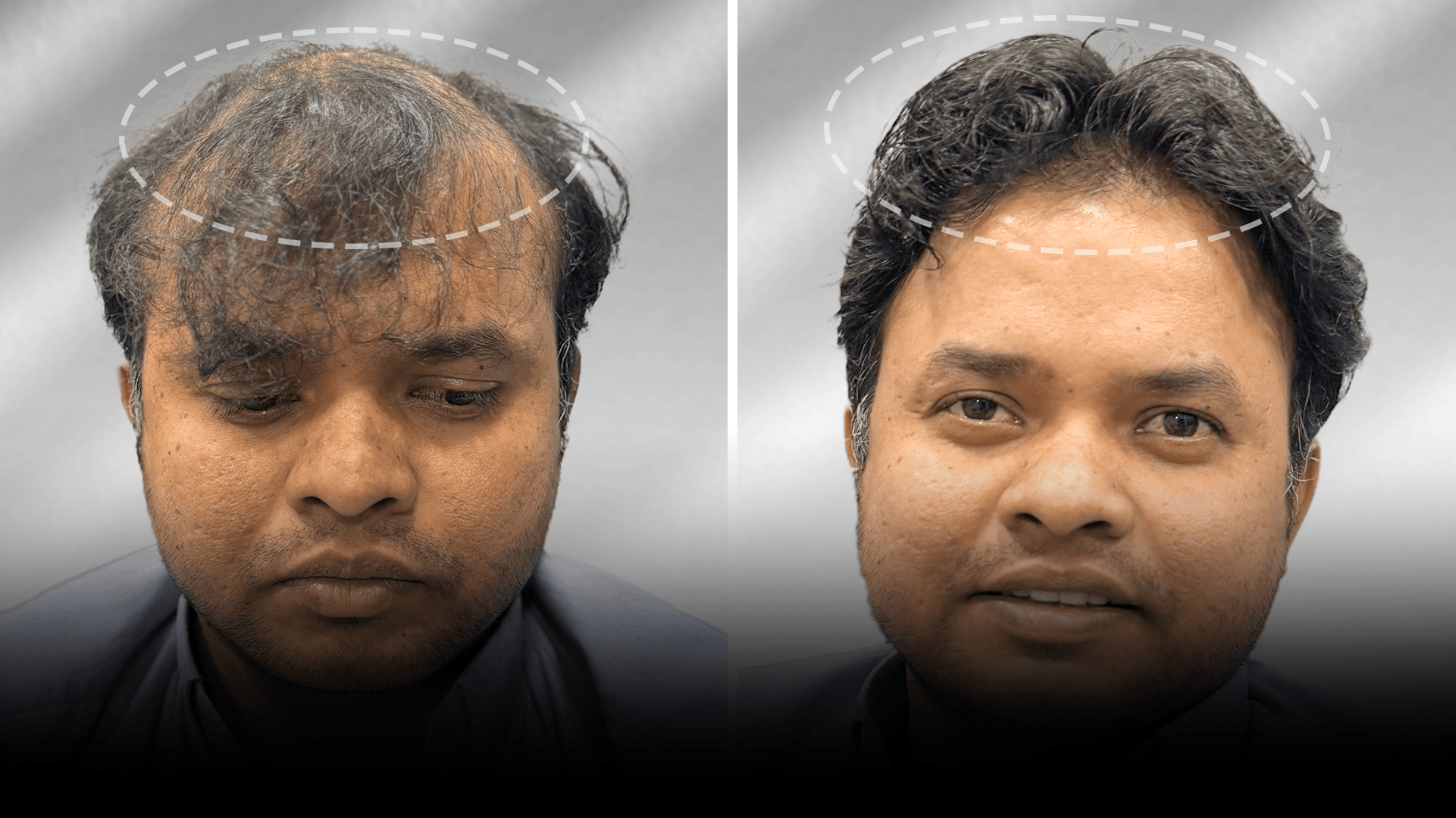 Before and after clip-on hair system result for Rahil Khan in the medium hair category.