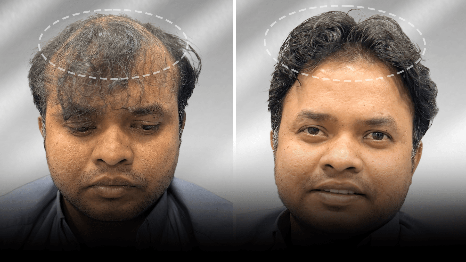 Before and after clip-on hair system result for Rahil Khan in the low density category.