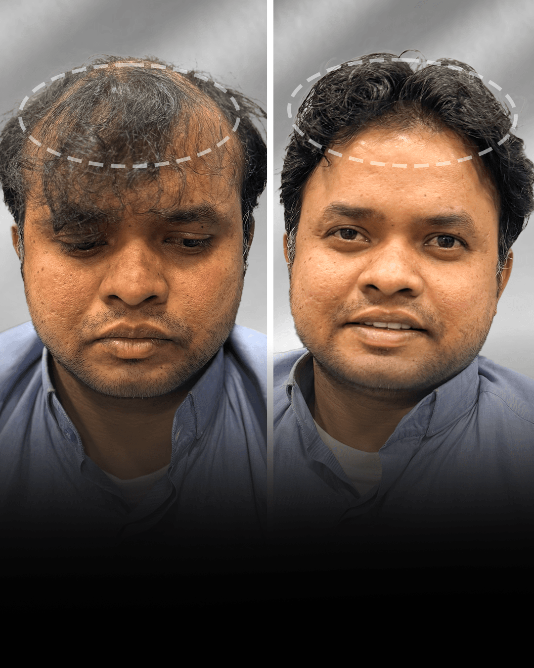 Before and after clip-on hair system result for Rahil Khan in the low density category.