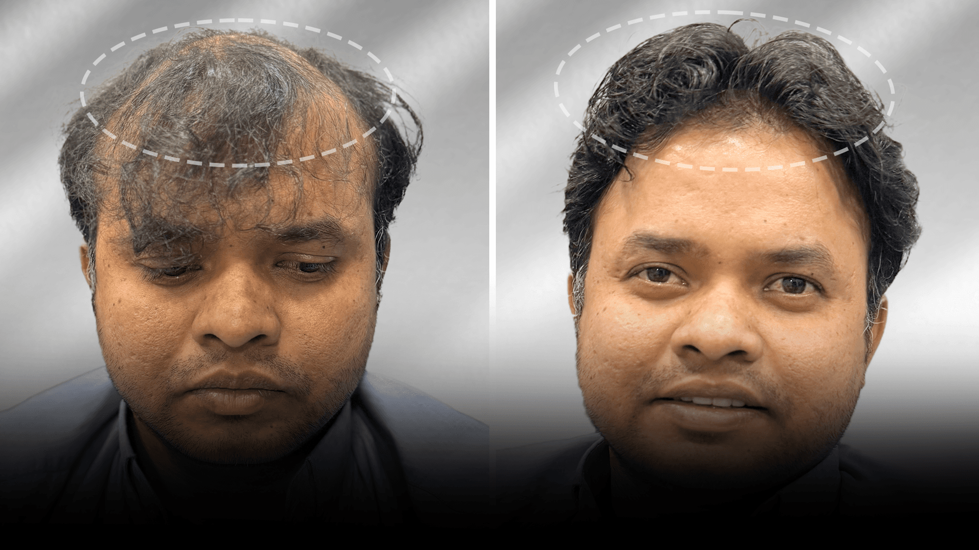Before and after clip-on hair system result for Rahil Khan.