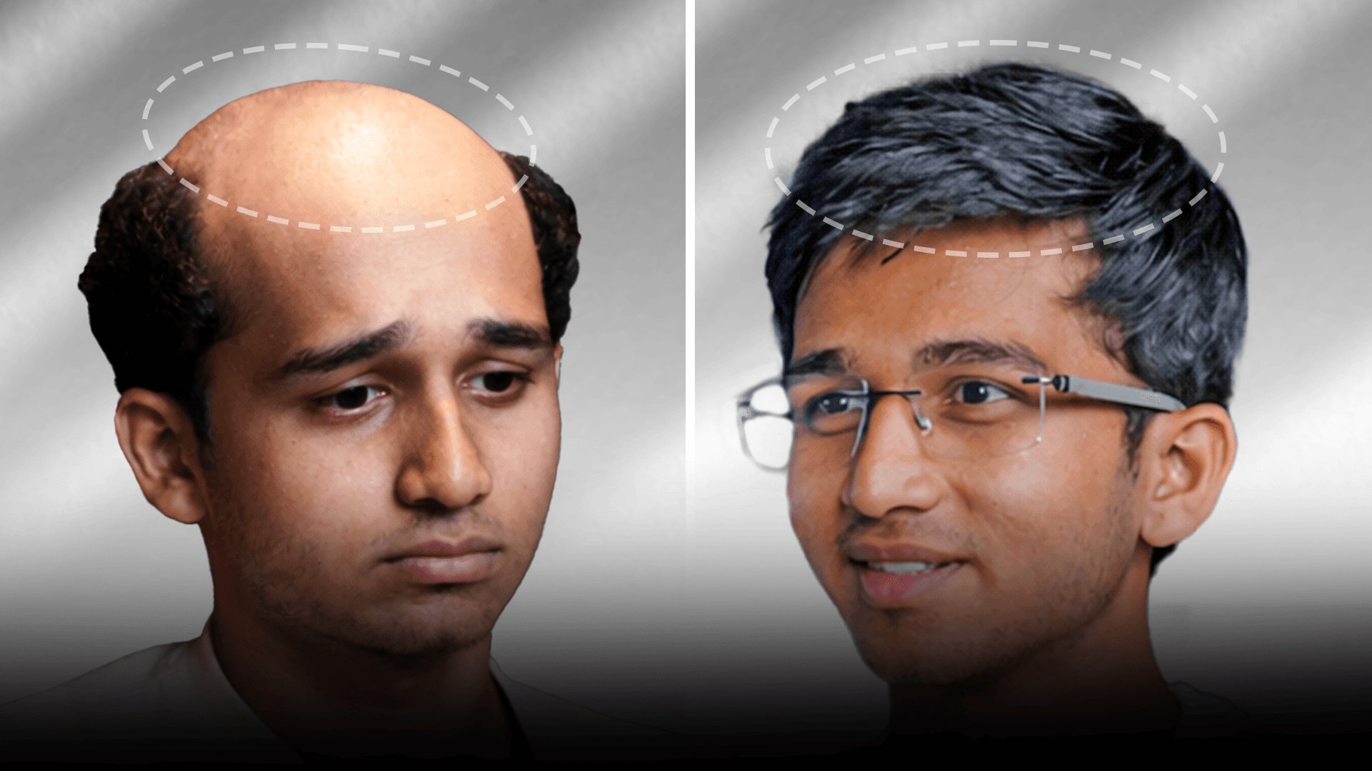 Before and after stick-on hair system result for Rohit Choudhary in the low density category.