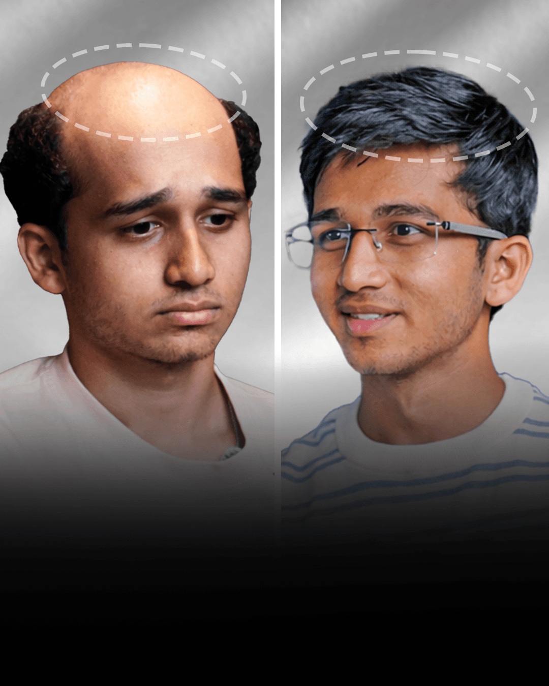 Before and after stick-on hair system result for Rohit Choudhary in the short hair category.