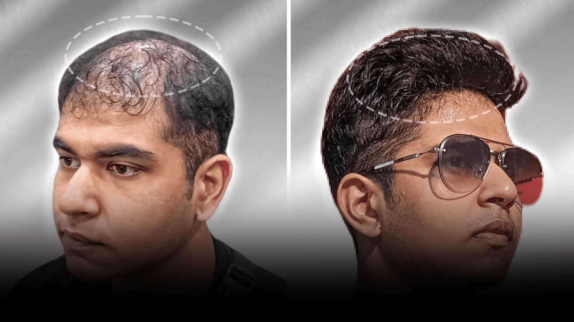 Before and after clip-on hair system result for Rylan Rodrigues in the medium hair category.