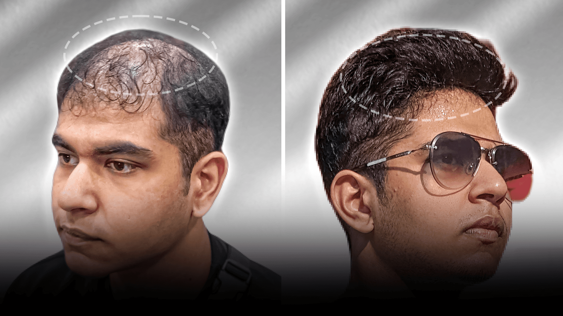 Before and after clip-on hair system result for Rylan Rodrigues in the high density category.