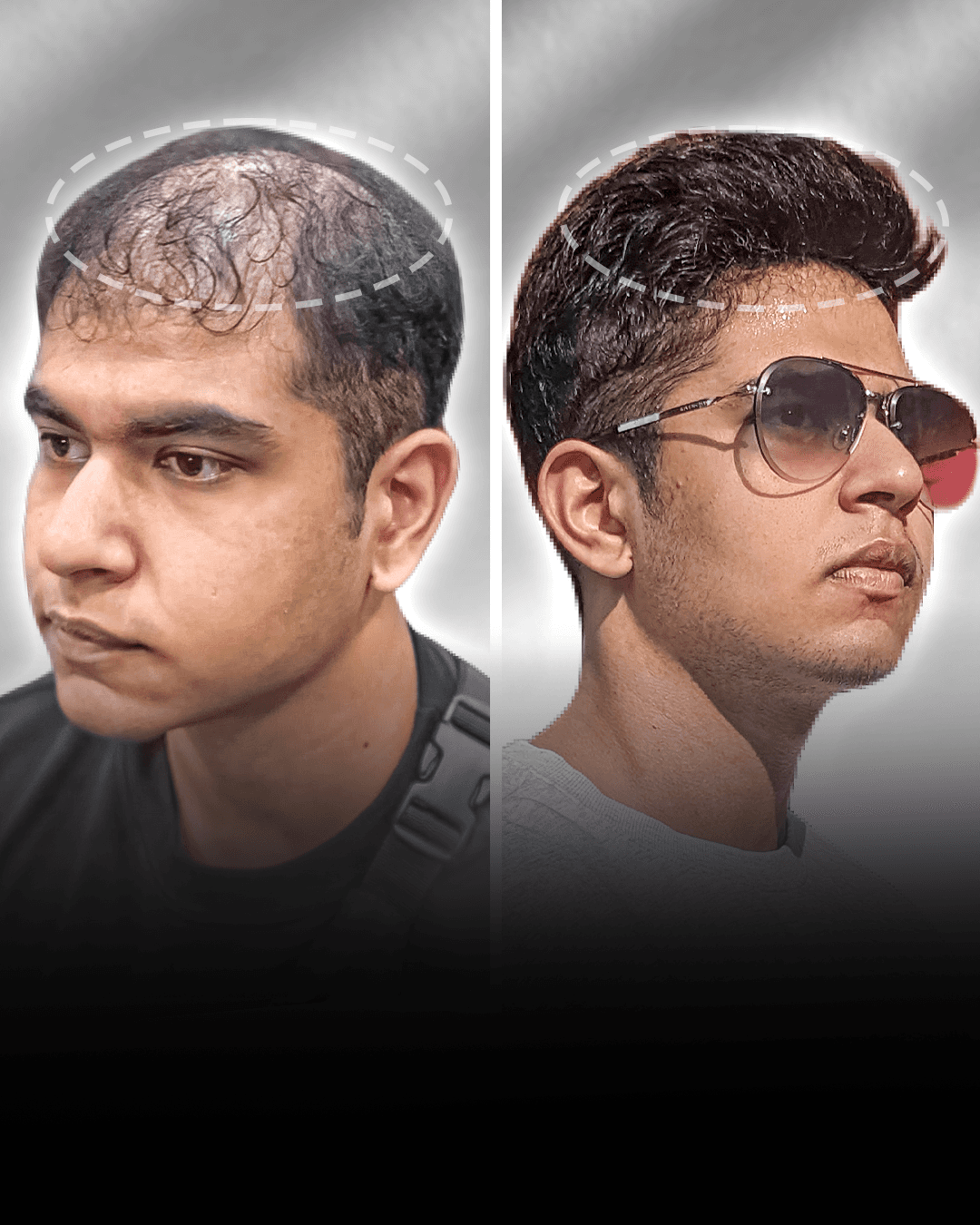 Before and after clip-on hair system result for Rylan Rodrigues.