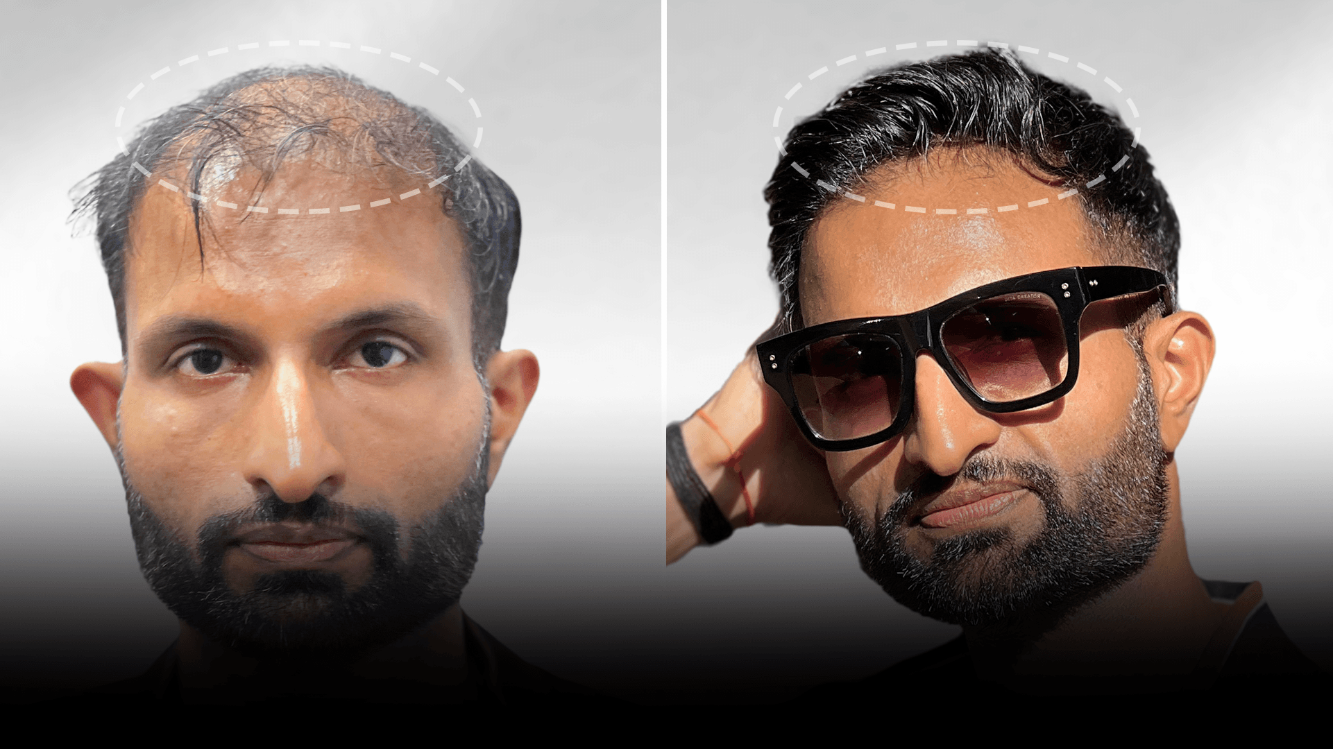 Before and after clip-on hair system result for Sahil Khan in the medium hair category.