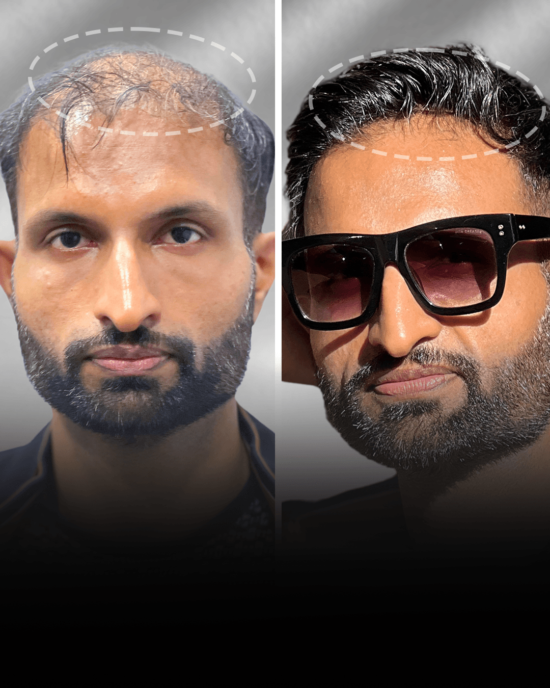 Before and after clip-on hair system result for Sahil Khan in the medium hair category.