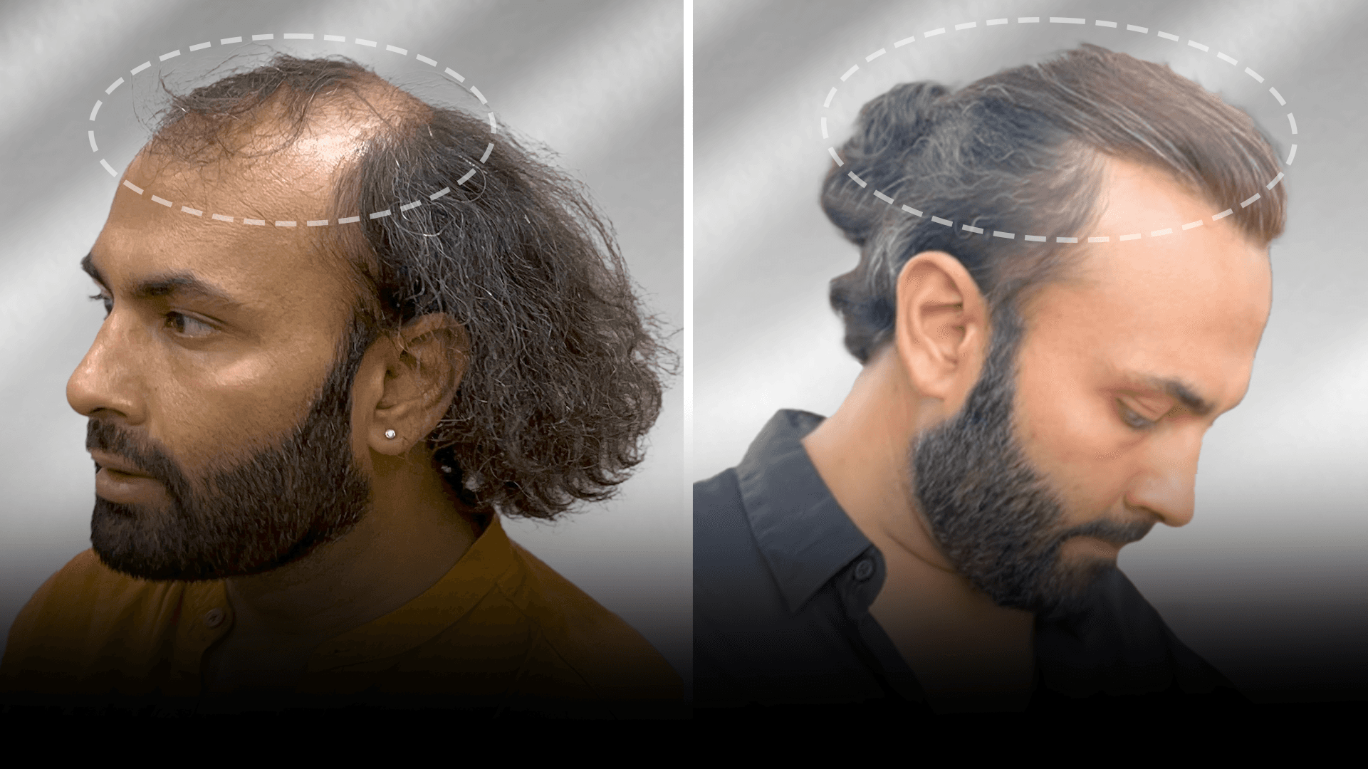 Before and after stick-on hair system result for Sanjay Kumar in the long hair category.