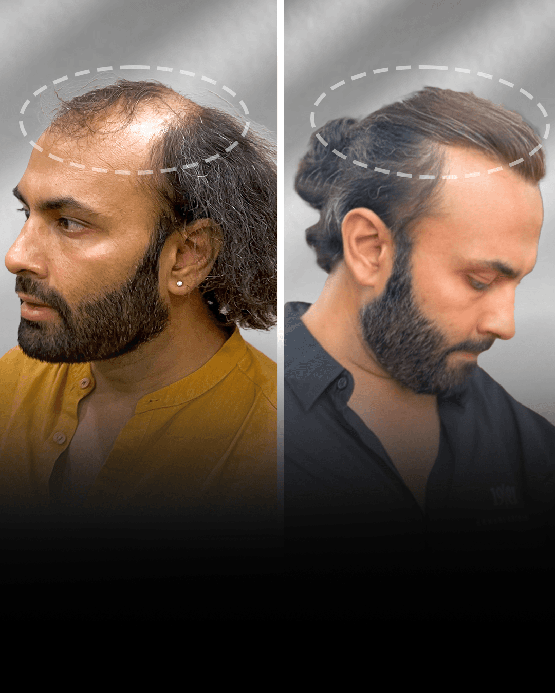 Before and after stick-on hair system result for Sanjay Kumar in the long hair category.