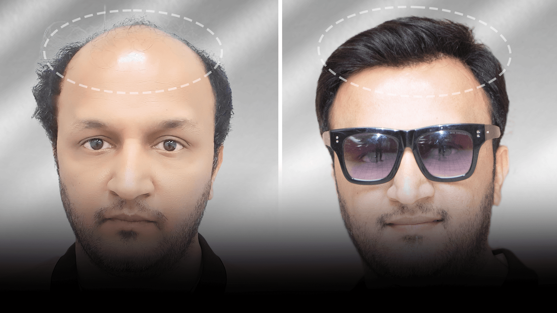 Before and after stick-on hair system result for Saurabh Mishra in the short hair category.