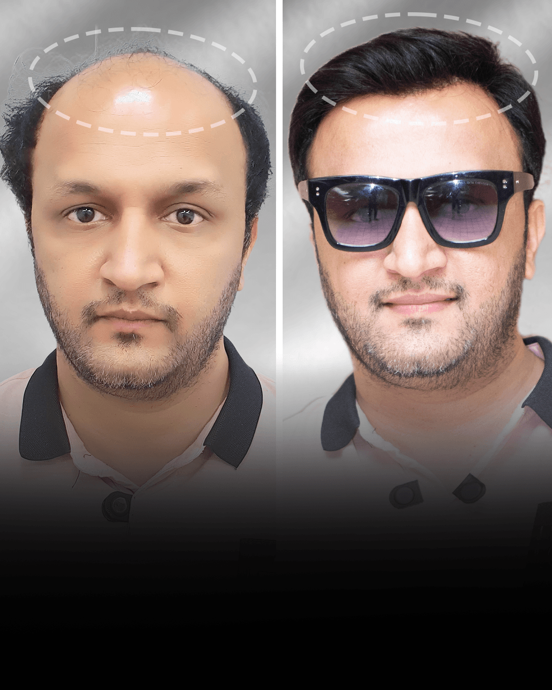 Before and after stick-on hair system result for Saurabh Mishra in the short hair category.