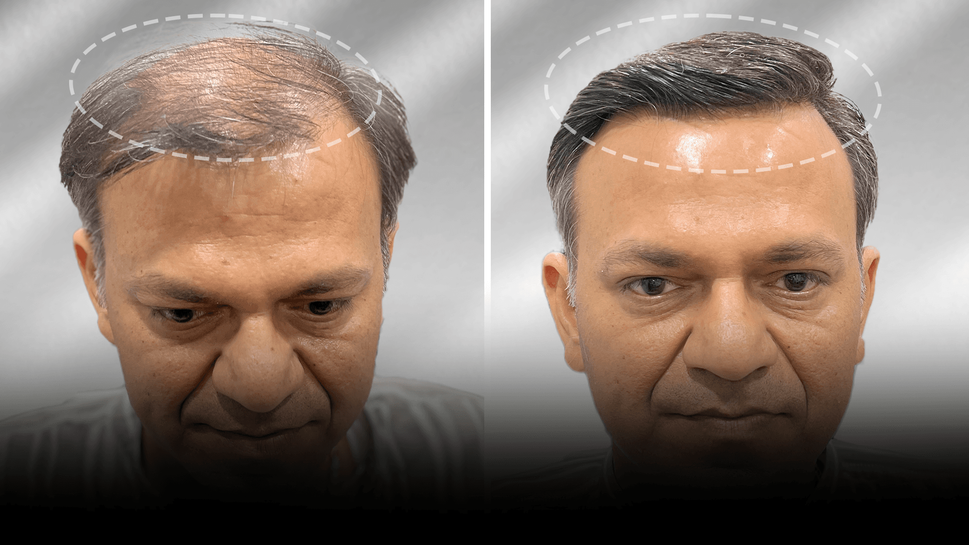 Before and after clip-on hair system result for Varun Desai in the high density category.