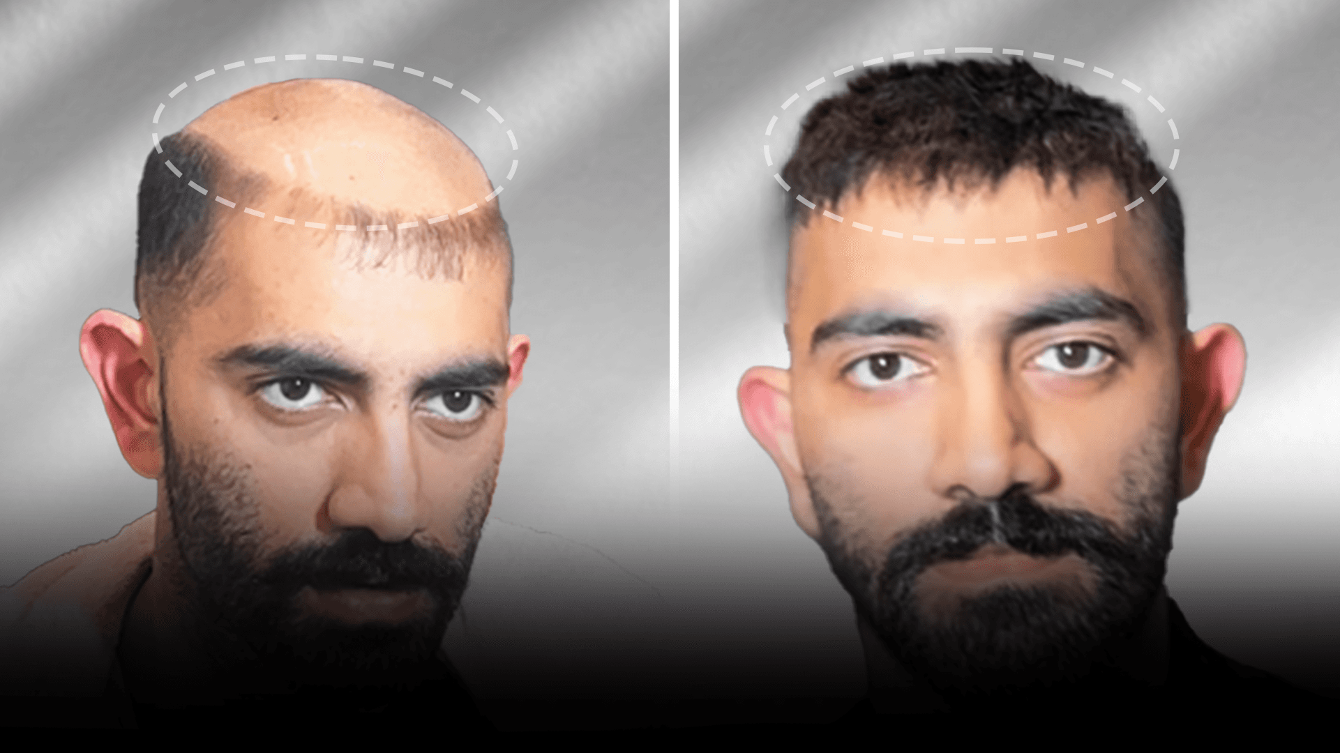 Before and after stick-on hair system result for Azhar Shaikh.